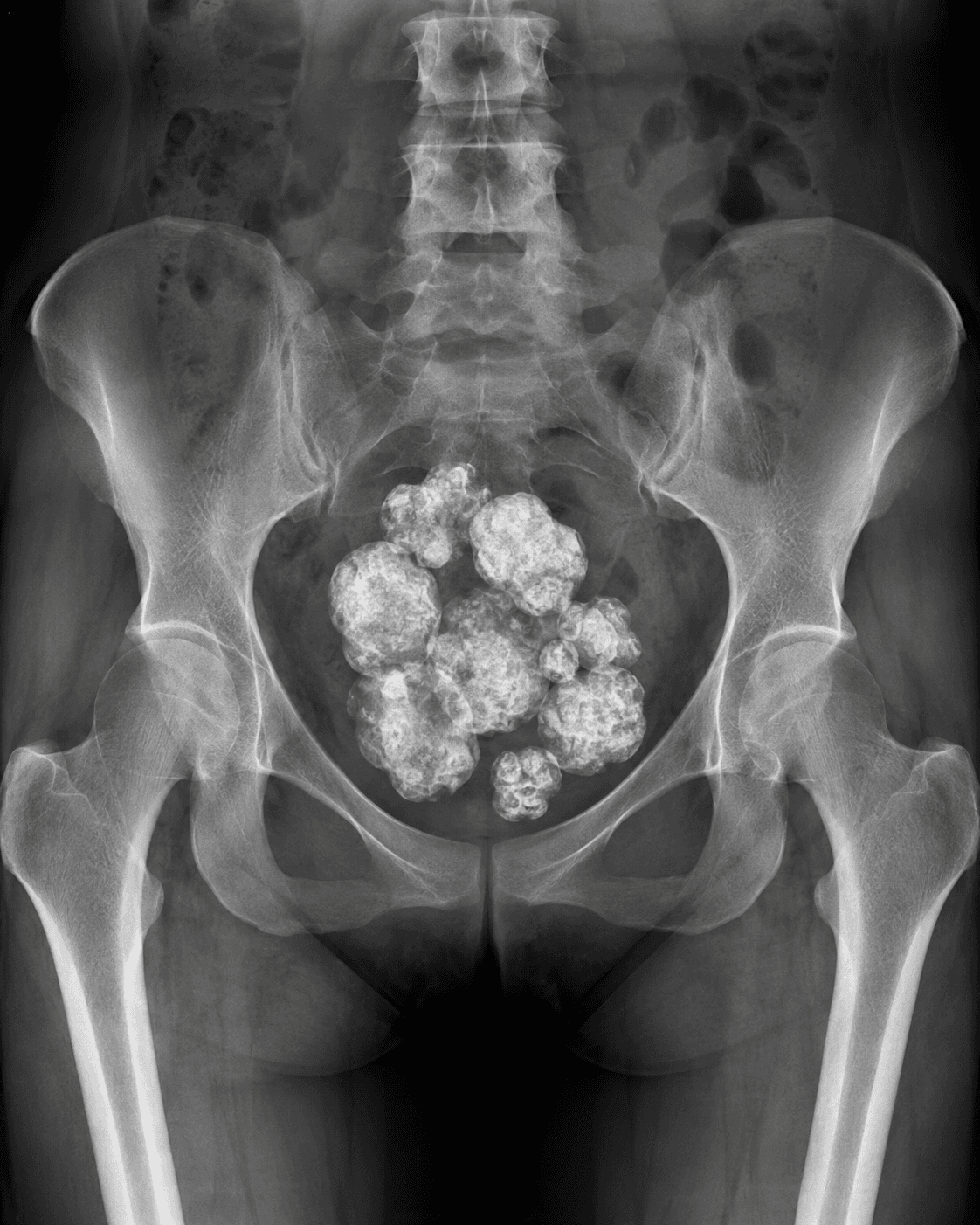 Popcorn in the Pelvis X-ray
