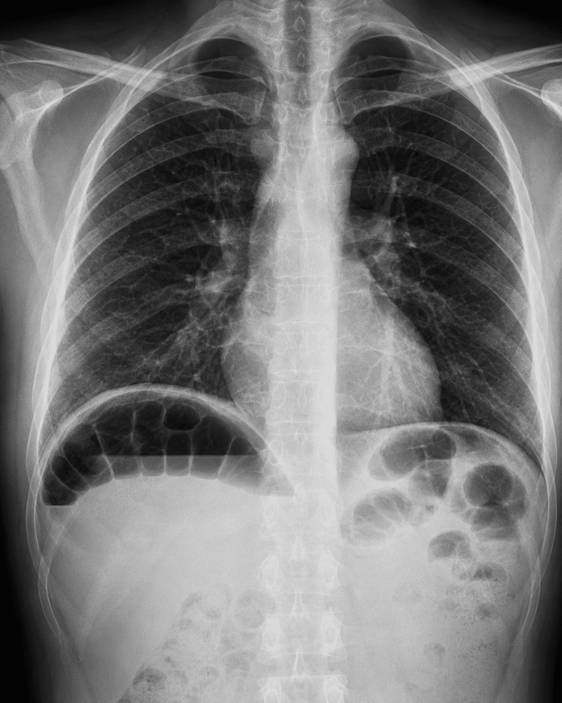 Colon Under the Diaphragm X-ray