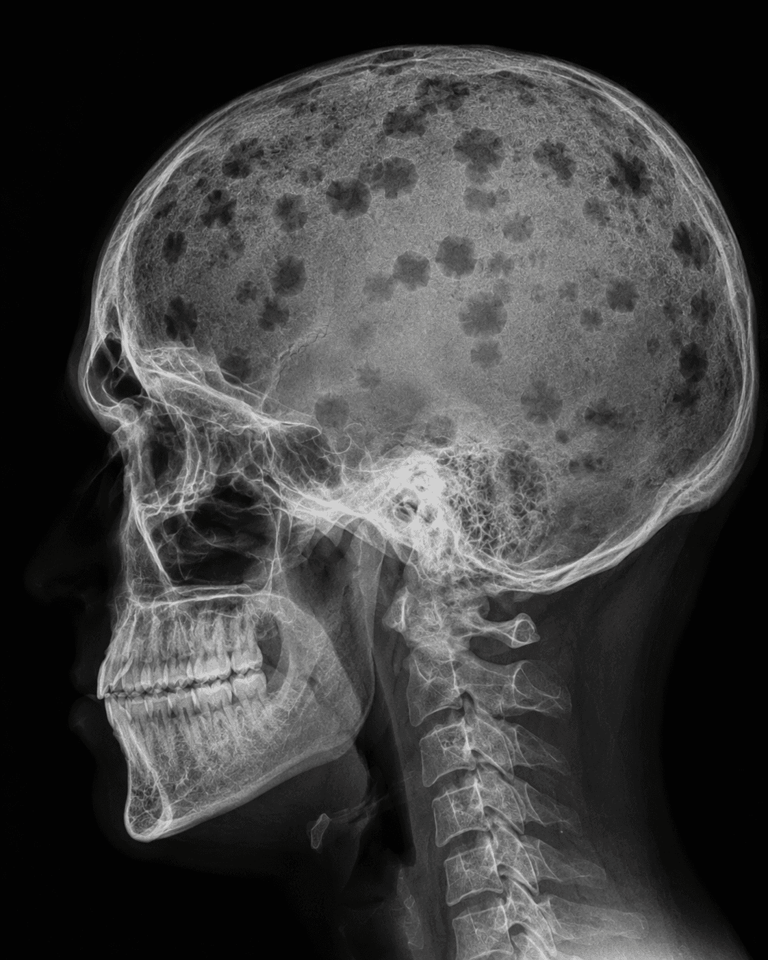 Punched-Out Skull X-ray